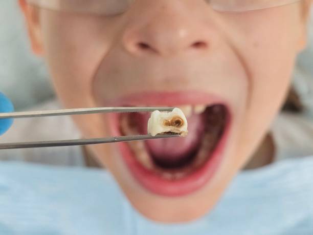 Best Cracked Tooth Emergency Dentist  in Melrose, MA